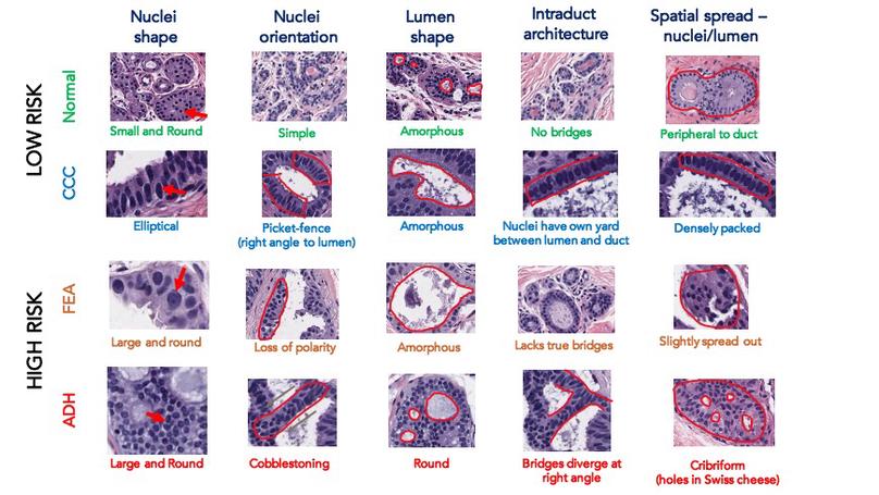 Modeling Histological Patterns for Differential Diagnosis of Atypical Breast Lesions